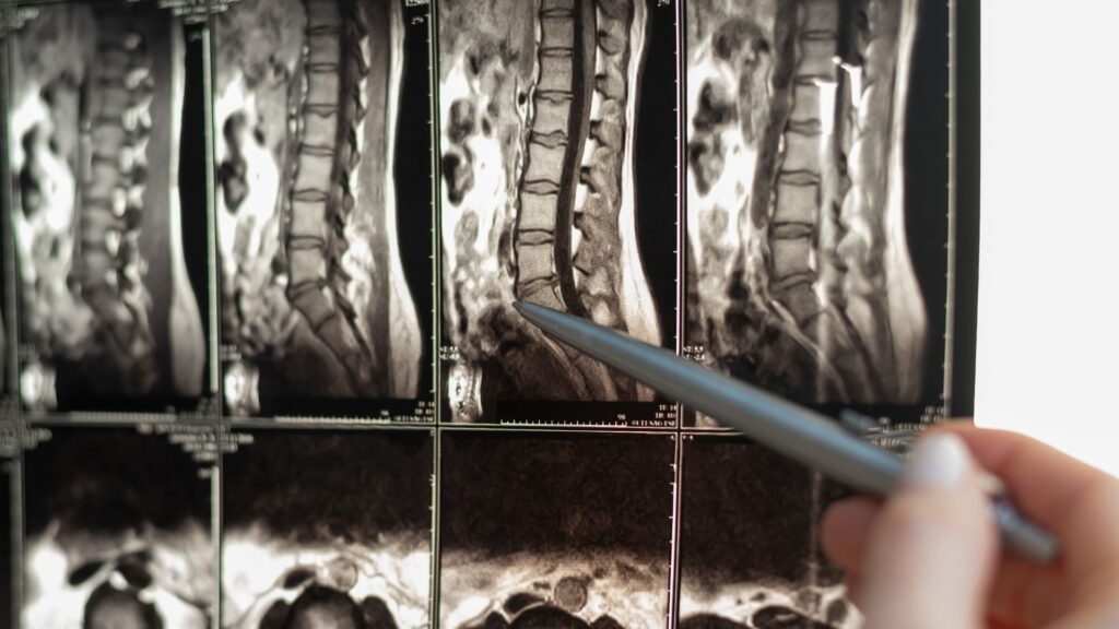An x-ray of a person's spinal cord.