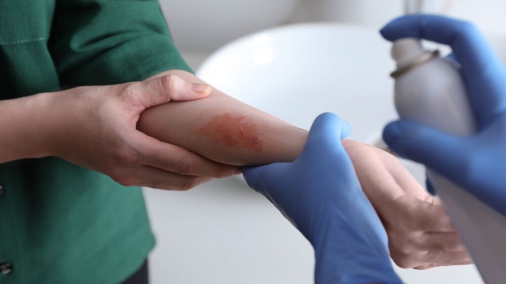 A doctor treating a person's burn injury with a spray.